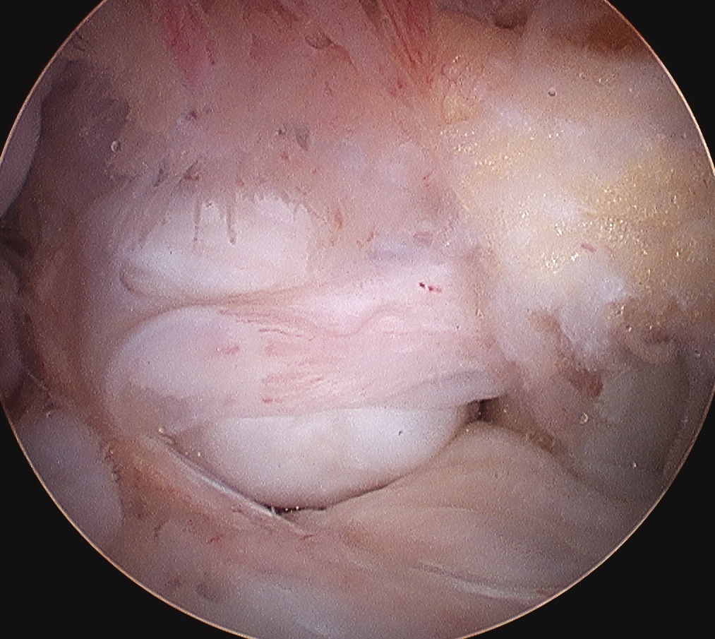 Knee Arthroscopy Hidden Loose Body